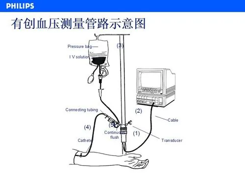 Electronic Sphygmomanometer or Mercury Sphygmomanometer?