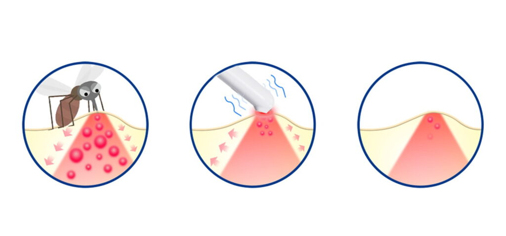 The Science Behind the Soothe and How Localized Heat Blocks Itch Signals